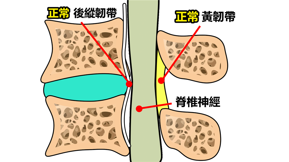 Spinal Stenosis
